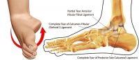 The Running Doctor: Dealing with ankle sprains