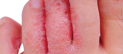 Change shoes in public places, be careful of mold infection